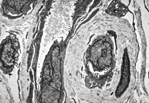 F, 48y. | lupus erythematodes … multiplicated vascular basement membrane F, 48y. | lupus erythematodes … multiplicated vascular basement membrane